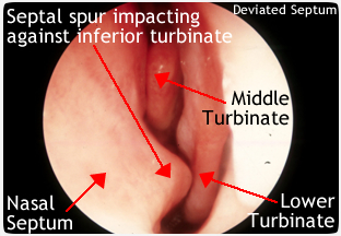 Sinus Conditions  Ohio State Medical Center