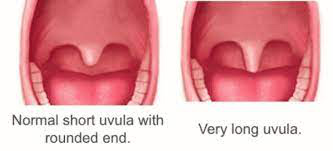 Noraml vs long uvula