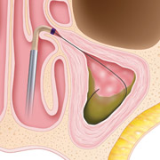 Image of: A small guide and soft, safe flexible wire is threaded into the sinus under the cheek.