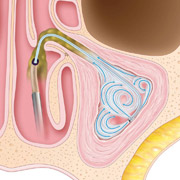 Image of: Infected mucus can be washed from the sinus to relieve pressure and pain and start the healing process.