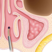 Image of: The sinus remains open after the procedure without packing or nasal dressing.