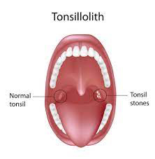 tonsillolith