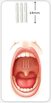 Pillar Procedure